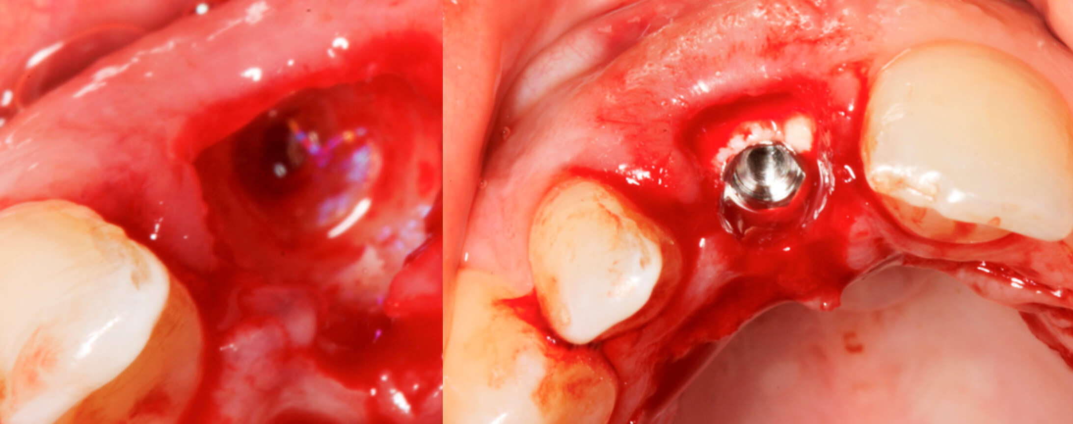 Detalle de la extracción e Imagen del implante inmediato post-extracción
