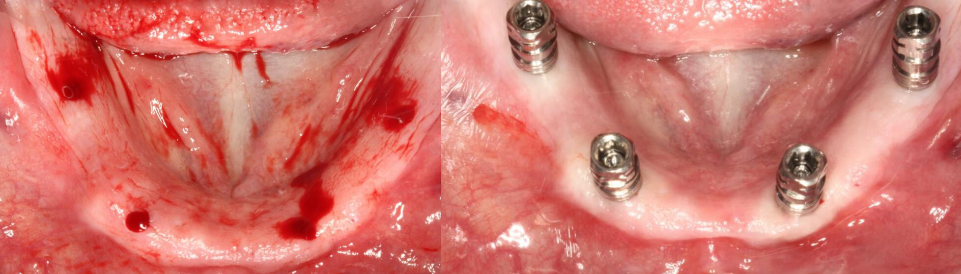 Detalle del fresado Y Vista de los implantes colocados