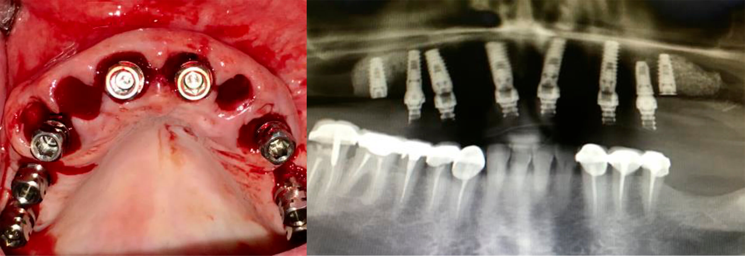 Implantes post-exodoncia en arcada superior y Rx de implantes y prótesis provisional atornillada