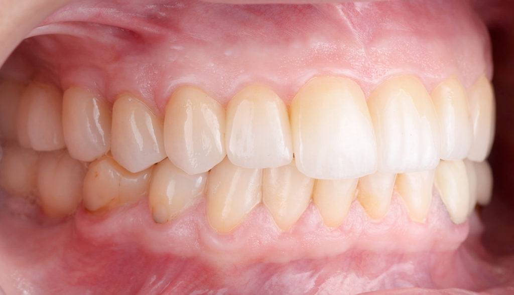 Detalles de las restauraciones definitivas del tratamiento de estética dental.