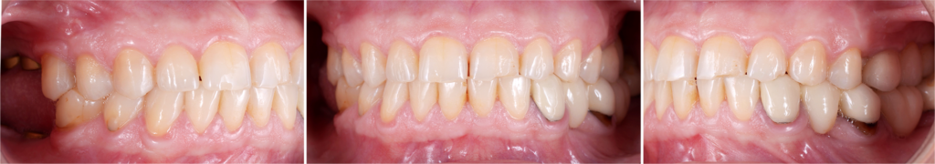 Situación incial de tratamiento de estética dental.