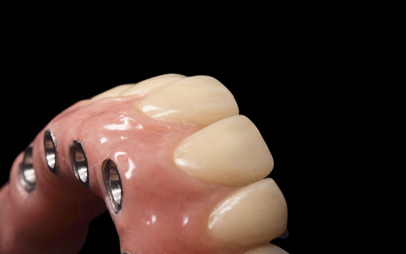 Detalle de la estructura dental de titanio acabada.