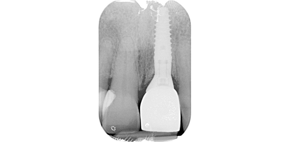 Rx del ajuste de la prótesis definitiva y del mantenimiento de los tejidos periimplantarios  