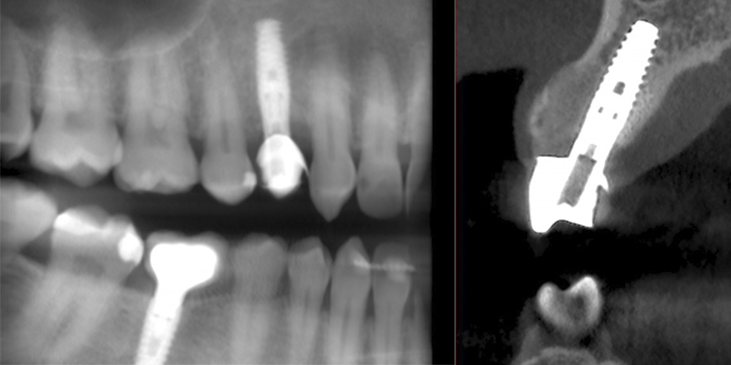 Imagen radiográfica de la corona provisional atornillada al implante unitario