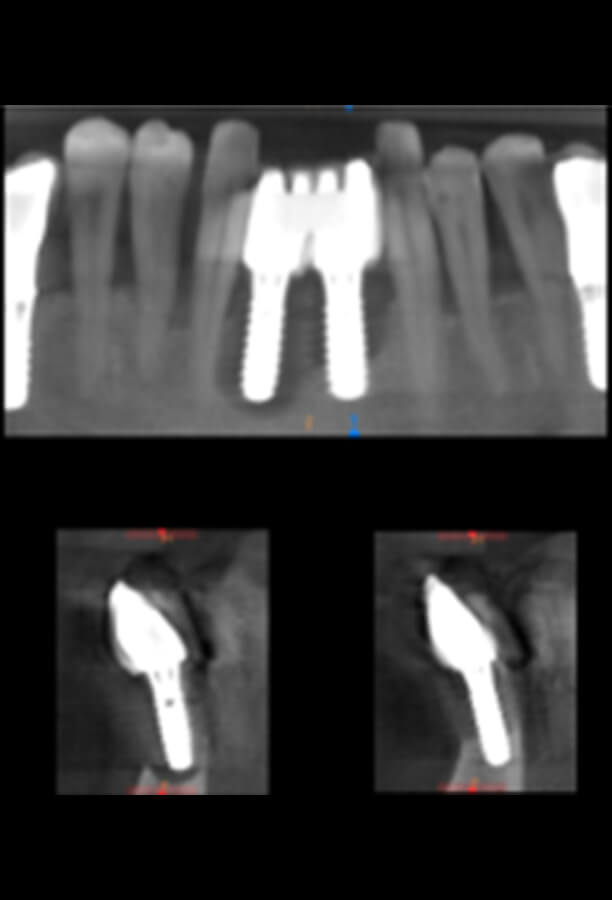 Situación inicial de marcada pérdida ósea alrededor de los implantes.
